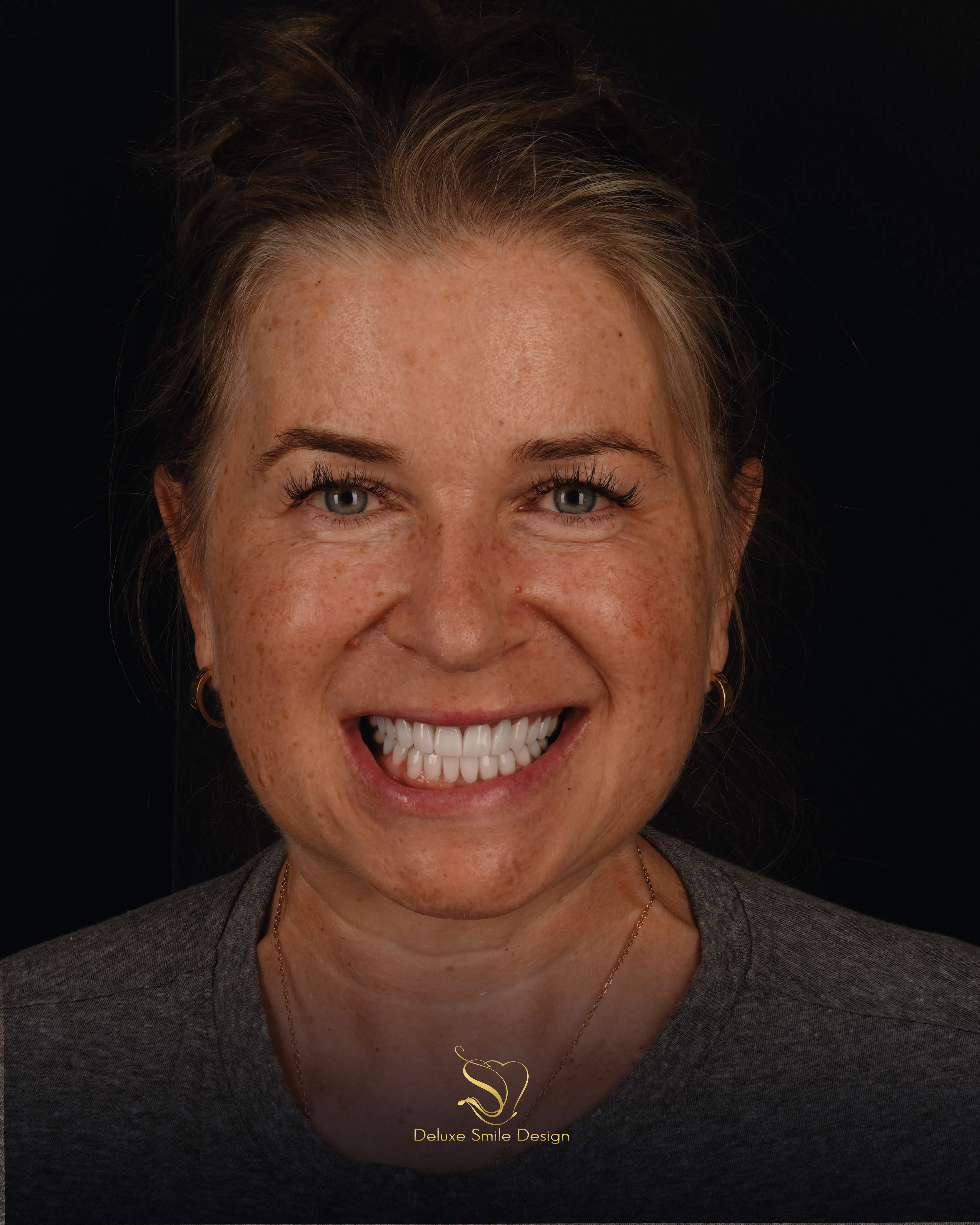 Deluxe Smile|Dental Implant Miami