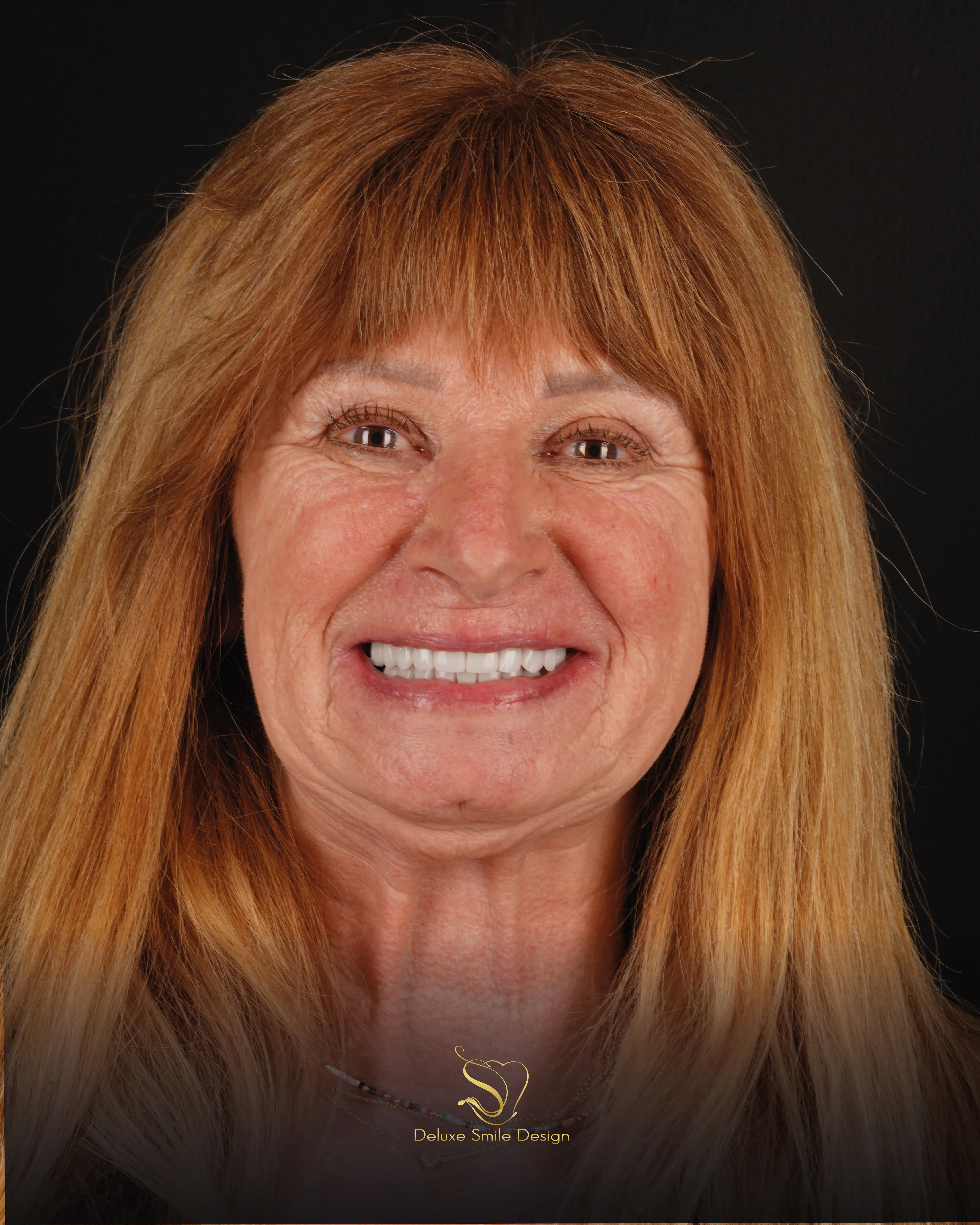 Deluxe Smile|<trp-post-container data-trp-post-id='5406'>Porcelain Veneers</trp-post-container>