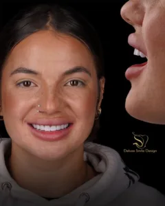 Do Porcelain Veneers Hurt?