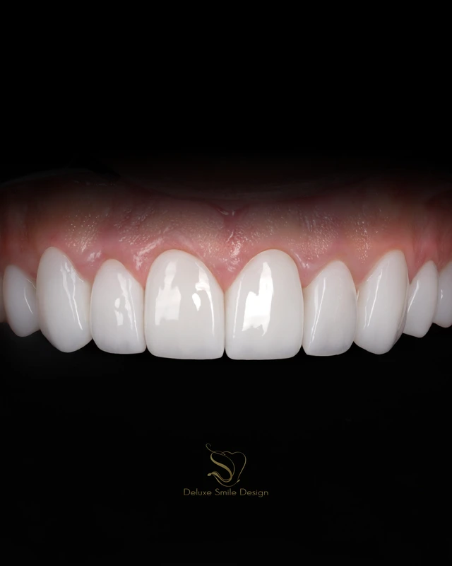 Foods to Eat & Avoid After Getting Porcelain Veneers Foods to Eat & Avoid After Getting Porcelain Veneers