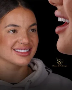 Natural-Looking Porcelain Veneers