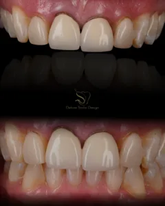 Porcelain Veneers Transform Your Smile