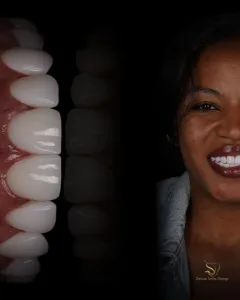 Porcelain veneers in Miami