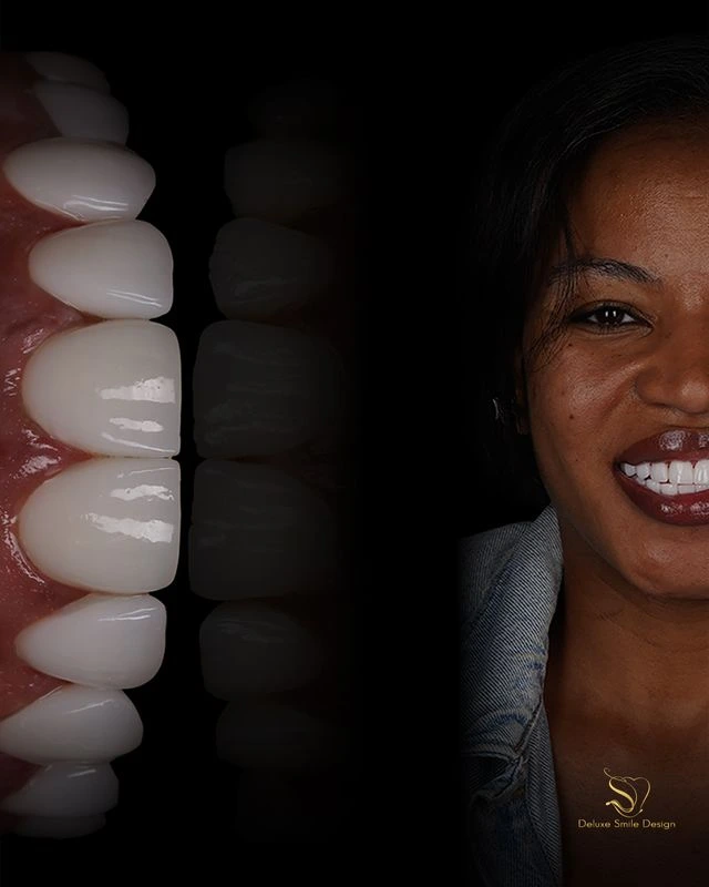 Porcelain veneers in Miami
