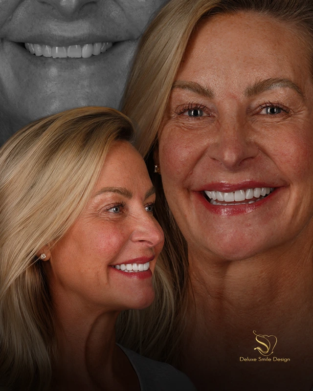 Smile Makeover