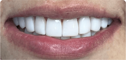 Deluxe Smile|Resin Veneers