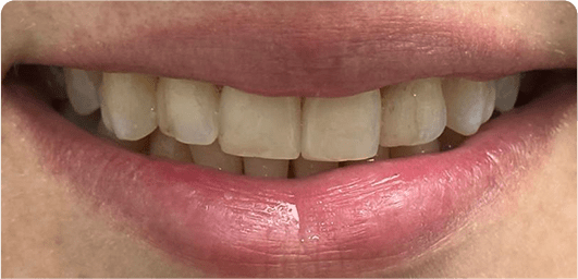 Deluxe Smile|Resin Veneers