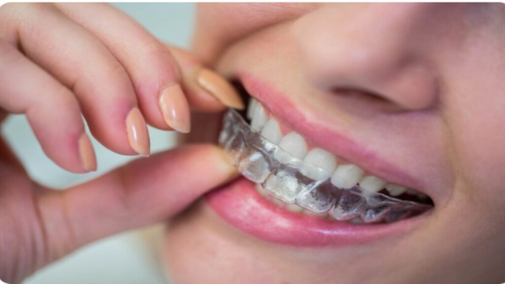 Person placing a clear aligner on their teeth with their hand.