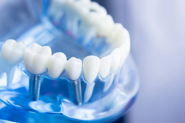 Deluxe Smile|Dental Implant