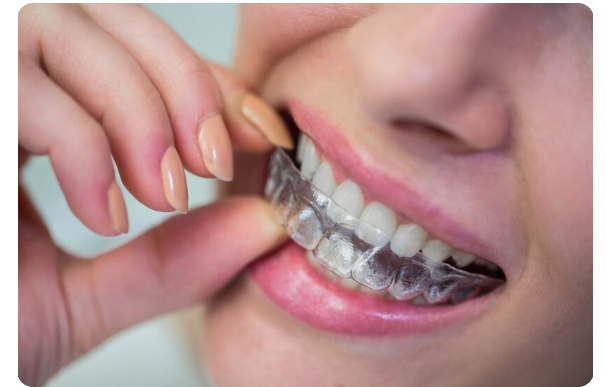 Deluxe Smile | Invisalign vs. Traditional Braces: Making the Right Choice Traditional Braces