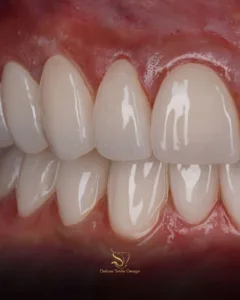 porcelain veneers dentist in Miami