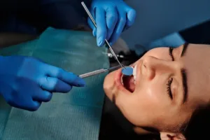 wisdom tooth extraction