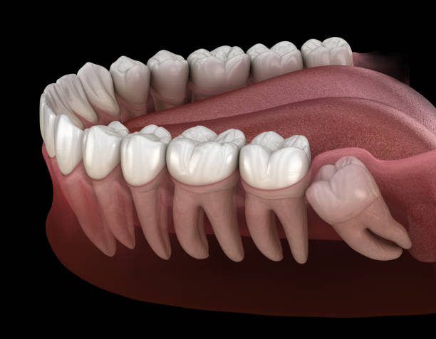 Deluxe Smile|Wisdom Tooth Removal