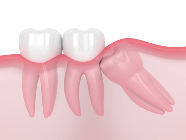 Deluxe Smile|Wisdom Tooth Removal